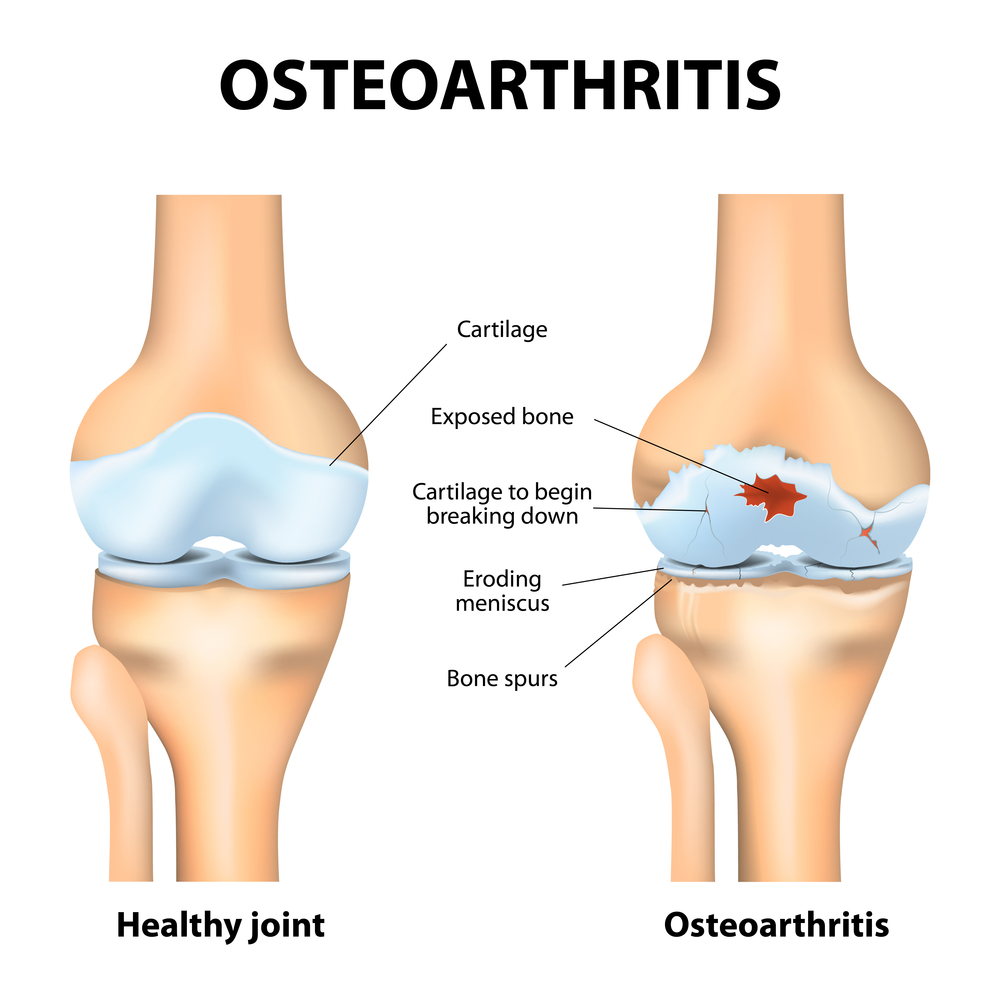 The difference between a healthy knee and one with osteoarthritis